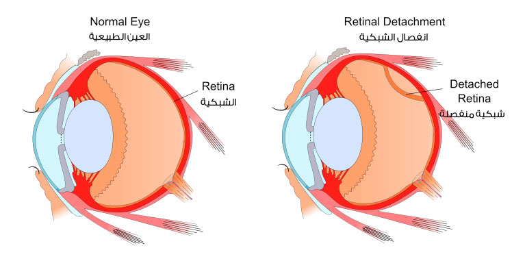 Retinal Detachment - Vitreo-Retinal Consultants