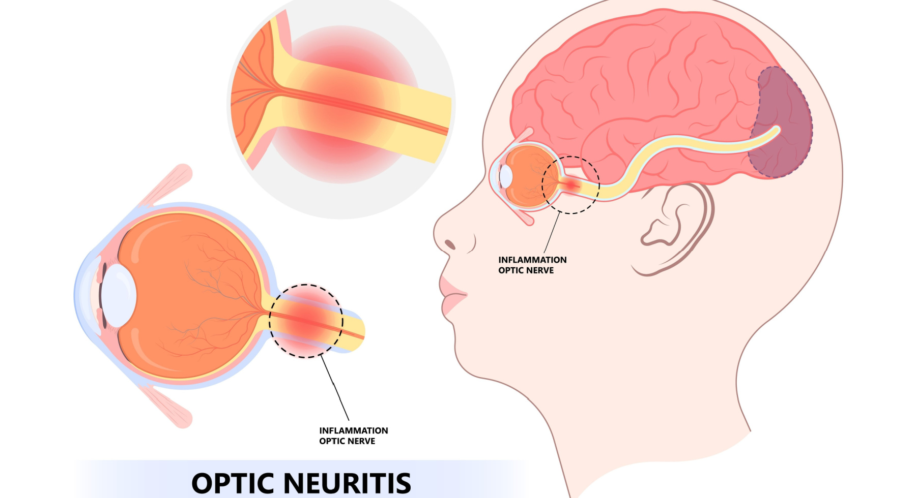 optic nerve brain