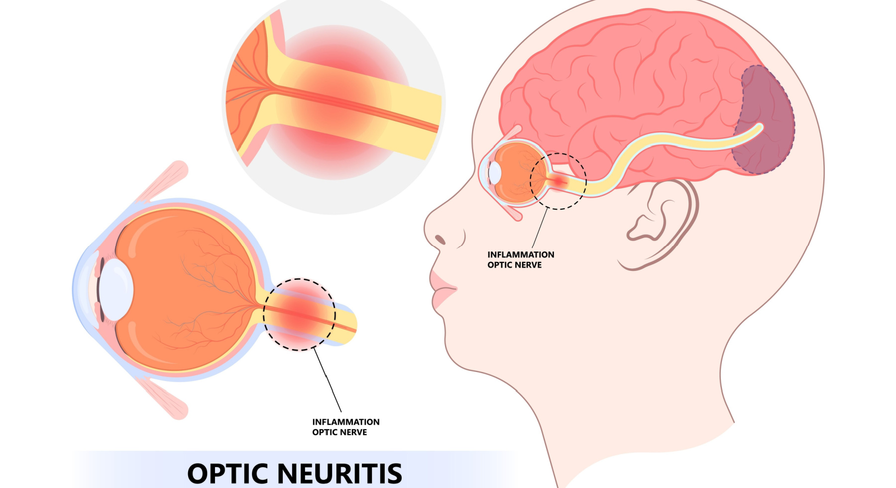 Optic Neuritis Symptoms Treatment Moorfields Eye Hospitals