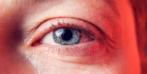 Close-up of the eye with tears often due duct inflammation, often associated with blocked tear drainage or dacryocystitis.